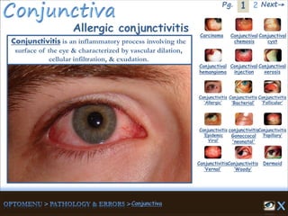 1Pg. 2 Next→
Allergic conjunctivitis
Conjunctivitis is an inflammatory process involving the
surface of the eye & characterized by vascular dilation,
cellular infiltration, & exudation.
Carcinoma Conjunctival
chemosis
Conjunctival
cyst
Conjunctival
hemangioma
Conjunctival
injection
Conjunctival
xerosis
Dermoid
Conjunctivitis
‘Allergic’
Conjunctivitis
‘Bacterial’
Conjunctivitis
‘Epidemic
Viral’
conjunctivitis
Gonoccocal
'neonatal'
Conjunctivitis
’Papillary’
Conjunctivitis
‘Vernal’
Conjunctivitis
‘Woody’
Conjunctivitis
‘Follicular’
 