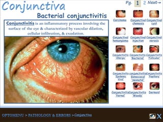 1Pg. 2 Next→
Bacterial conjunctivitis Carcinoma Conjunctival
chemosis
Conjunctival
cyst
Conjunctival
hemangioma
Conjunctival
injection
Conjunctival
xerosis
Dermoid
Conjunctivitis
‘Allergic’
Conjunctivitis
‘Bacterial’
Conjunctivitis
‘Epidemic
Viral’
conjunctivitis
Gonoccocal
'neonatal'
Conjunctivitis
’Papillary’
Conjunctivitis
‘Vernal’
Conjunctivitis
‘Woody’
Conjunctivitis
‘Follicular’
Conjunctivitis is an inflammatory process involving the
surface of the eye & characterized by vascular dilation,
cellular infiltration, & exudation.
 