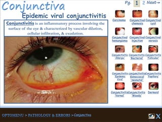 1Pg. 2 Next→
Epidemic viral conjunctivitis Carcinoma Conjunctival
chemosis
Conjunctival
cyst
Conjunctival
hemangioma
Conjunctival
injection
Conjunctival
xerosis
Dermoid
Conjunctivitis
‘Allergic’
Conjunctivitis
‘Bacterial’
Conjunctivitis
‘Epidemic
Viral’
conjunctivitis
Gonoccocal
'neonatal'
Conjunctivitis
’Papillary’
Conjunctivitis
‘Vernal’
Conjunctivitis
‘Woody’
Conjunctivitis
‘Follicular’
Conjunctivitis is an inflammatory process involving the
surface of the eye & characterized by vascular dilation,
cellular infiltration, & exudation.
 