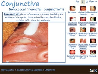 1Pg. 2 Next→
Gonoccocal 'neonatal‘ conjunctivitis
Carcinoma Conjunctival
chemosis
Conjunctival
cyst
Conjunctival
hemangioma
Conjunctival
injection
Conjunctival
xerosis
Dermoid
Conjunctivitis
‘Allergic’
Conjunctivitis
‘Bacterial’
Conjunctivitis
‘Epidemic
Viral’
conjunctivitis
Gonoccocal
'neonatal'
Conjunctivitis
’Papillary’
Conjunctivitis
‘Vernal’
Conjunctivitis
‘Woody’
Conjunctivitis
‘Follicular’
Conjunctivitis is an inflammatory process involving the
surface of the eye & characterized by vascular dilation,
cellular infiltration, & exudation.
 