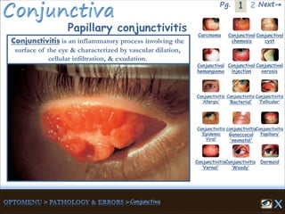 1Pg. 2 Next→
Papillary conjunctivitis Carcinoma Conjunctival
chemosis
Conjunctival
cyst
Conjunctival
hemangioma
Conjunctival
injection
Conjunctival
xerosis
Dermoid
Conjunctivitis
‘Allergic’
Conjunctivitis
‘Bacterial’
Conjunctivitis
‘Epidemic
Viral’
conjunctivitis
Gonoccocal
'neonatal'
Conjunctivitis
’Papillary’
Conjunctivitis
‘Vernal’
Conjunctivitis
‘Woody’
Conjunctivitis
‘Follicular’
Conjunctivitis is an inflammatory process involving the
surface of the eye & characterized by vascular dilation,
cellular infiltration, & exudation.
 