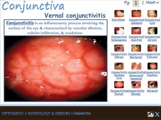 1Pg. 2 Next→
Vernal conjunctivitis Carcinoma Conjunctival
chemosis
Conjunctival
cyst
Conjunctival
hemangioma
Conjunctival
injection
Conjunctival
xerosis
Dermoid
Conjunctivitis
‘Allergic’
Conjunctivitis
‘Bacterial’
Conjunctivitis
‘Epidemic
Viral’
conjunctivitis
Gonoccocal
'neonatal'
Conjunctivitis
’Papillary’
Conjunctivitis
‘Vernal’
Conjunctivitis
‘Woody’
Conjunctivitis
‘Follicular’
Conjunctivitis is an inflammatory process involving the
surface of the eye & characterized by vascular dilation,
cellular infiltration, & exudation.
 