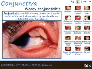 1Pg. 2 Next→
Woody conjunctivitis Carcinoma Conjunctival
chemosis
Conjunctival
cyst
Conjunctival
hemangioma
Conjunctival
injection
Conjunctival
xerosis
Dermoid
Conjunctivitis
‘Allergic’
Conjunctivitis
‘Bacterial’
Conjunctivitis
‘Epidemic
Viral’
conjunctivitis
Gonoccocal
'neonatal'
Conjunctivitis
’Papillary’
Conjunctivitis
‘Vernal’
Conjunctivitis
‘Woody’
Conjunctivitis
‘Follicular’
Conjunctivitis is an inflammatory process involving the
surface of the eye & characterized by vascular dilation,
cellular infiltration, & exudation.
 