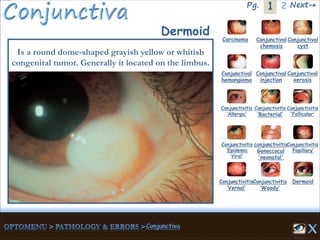 1Pg. 2 Next→
Dermoid
Is a round dome-shaped grayish yellow or whitish
congenital tumor. Generally it located on the limbus.
Carcinoma Conjunctival
chemosis
Conjunctival
cyst
Conjunctival
hemangioma
Conjunctival
injection
Conjunctival
xerosis
Dermoid
Conjunctivitis
‘Allergic’
Conjunctivitis
‘Bacterial’
Conjunctivitis
‘Epidemic
Viral’
conjunctivitis
Gonoccocal
'neonatal'
Conjunctivitis
’Papillary’
Conjunctivitis
‘Vernal’
Conjunctivitis
‘Woody’
Conjunctivitis
‘Follicular’
 