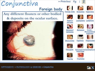 2←Previous 1Pg.
Granuloma Hyperemia
Kaposi’s
sarcoma
Foreign body
Leukoplakia Lymphoma
Malignent
melanoma
Melanosis Ocular-
Mucocutaneous
syndromes
Oncocytoma Papilloma Pingueculum
Pterygium Subconjunctival
hemorrhage
Symblepharon
Tearing Trachoma
Foreign body
Any different floaters or other bodied
& deposits on the ocular surface.
 