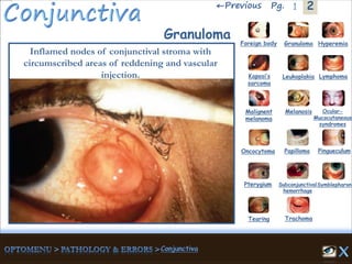 2←Previous 1Pg.
Granuloma
Inflamed nodes of conjunctival stroma with
circumscribed areas of reddening and vascular
injection.
Granuloma Hyperemia
Kaposi’s
sarcoma
Foreign body
Leukoplakia Lymphoma
Malignent
melanoma
Melanosis Ocular-
Mucocutaneous
syndromes
Oncocytoma Papilloma Pingueculum
Pterygium Subconjunctival
hemorrhage
Symblepharon
Tearing Trachoma
 