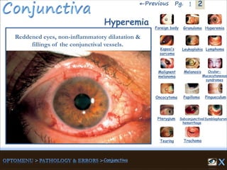 2←Previous 1Pg.
Hyperemia
Reddened eyes, non-inflammatory dilatation &
fillings of the conjunctival vessels.
Granuloma Hyperemia
Kaposi’s
sarcoma
Foreign body
Leukoplakia Lymphoma
Malignent
melanoma
Melanosis Ocular-
Mucocutaneous
syndromes
Oncocytoma Papilloma Pingueculum
Pterygium Subconjunctival
hemorrhage
Symblepharon
Tearing Trachoma
 