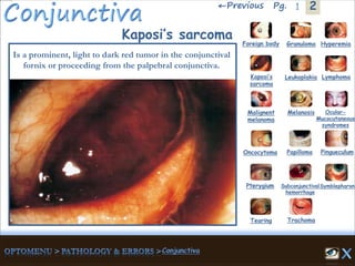 2←Previous 1Pg.
Kaposi’s sarcoma
Is a prominent, light to dark red tumor in the conjunctival
fornix or proceeding from the palpebral conjunctiva.
Granuloma Hyperemia
Kaposi’s
sarcoma
Foreign body
Leukoplakia Lymphoma
Malignent
melanoma
Melanosis Ocular-
Mucocutaneous
syndromes
Oncocytoma Papilloma Pingueculum
Pterygium Subconjunctival
hemorrhage
Symblepharon
Tearing Trachoma
 