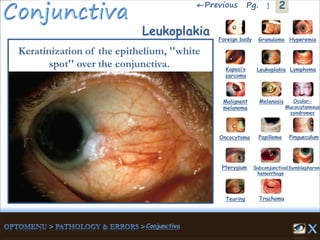 2←Previous 1Pg.
Leukoplakia
Keratinization of the epithelium, ''white
spot'' over the conjunctiva.
Granuloma Hyperemia
Kaposi’s
sarcoma
Foreign body
Leukoplakia Lymphoma
Malignent
melanoma
Melanosis Ocular-
Mucocutaneous
syndromes
Oncocytoma Papilloma Pingueculum
Pterygium Subconjunctival
hemorrhage
Symblepharon
Tearing Trachoma
 