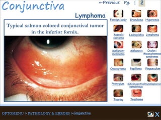 2←Previous 1Pg.
Lymphoma
Typical salmon colored conjunctival tumor
in the inferior fornix.
Granuloma Hyperemia
Kaposi’s
sarcoma
Foreign body
Leukoplakia Lymphoma
Malignent
melanoma
Melanosis Ocular-
Mucocutaneous
syndromes
Oncocytoma Papilloma Pingueculum
Pterygium Subconjunctival
hemorrhage
Symblepharon
Tearing Trachoma
 
