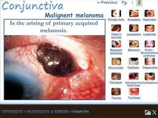 2←Previous 1Pg.
Malignent melanoma
Is the arising of primary acquired
melanosis.
Granuloma Hyperemia
Kaposi’s
sarcoma
Foreign body
Leukoplakia Lymphoma
Malignent
melanoma
Melanosis Ocular-
Mucocutaneous
syndromes
Oncocytoma Papilloma Pingueculum
Pterygium Subconjunctival
hemorrhage
Symblepharon
Tearing Trachoma
 