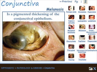 2←Previous 1Pg.
Melanosis
Is a pigmented thickening of the
conjunctival epithelium.
Granuloma Hyperemia
Kaposi’s
sarcoma
Foreign body
Leukoplakia Lymphoma
Malignent
melanoma
Melanosis Ocular-
Mucocutaneous
syndromes
Oncocytoma Papilloma Pingueculum
Pterygium Subconjunctival
hemorrhage
Symblepharon
Tearing Trachoma
 
