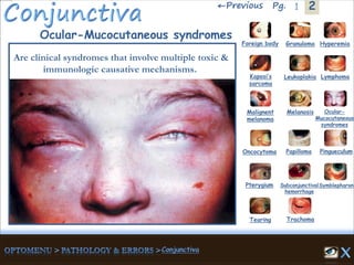 2←Previous 1Pg.
Ocular-Mucocutaneous syndromes
Are clinical syndromes that involve multiple toxic &
immunologic causative mechanisms.
Granuloma Hyperemia
Kaposi’s
sarcoma
Foreign body
Leukoplakia Lymphoma
Malignent
melanoma
Melanosis Ocular-
Mucocutaneous
syndromes
Oncocytoma Papilloma Pingueculum
Pterygium Subconjunctival
hemorrhage
Symblepharon
Tearing Trachoma
 