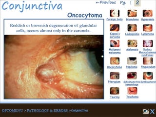 2←Previous 1Pg.
Oncocytoma
Reddish or brownish degeneration of glandular
cells, occurs almost only in the caruncle.
Granuloma Hyperemia
Kaposi’s
sarcoma
Foreign body
Leukoplakia Lymphoma
Malignent
melanoma
Melanosis Ocular-
Mucocutaneous
syndromes
Oncocytoma Papilloma Pingueculum
Pterygium Subconjunctival
hemorrhage
Symblepharon
Tearing Trachoma
 
