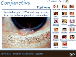 2←Previous 1Pg.
Papilloma Granuloma Hyperemia
Kaposi’s
sarcoma
Foreign body
Leukoplakia Lymphoma
Malignent
melanoma
Melanosis Ocular-
Mucocutaneous
syndromes
Oncocytoma Papilloma Pingueculum
Pterygium Subconjunctival
hemorrhage
Symblepharon
Tearing Trachoma
Is a viral origin (HPVs), and may develop
from the bulbar or palpebral conjunctiva.
 