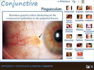 2←Previous 1Pg.
Pingueculum
Harmless grayish yellow thickening of the
conjunctival epithelium in the palpebral fissure.
Granuloma Hyperemia
Kaposi’s
sarcoma
Foreign body
Leukoplakia Lymphoma
Malignent
melanoma
Melanosis Ocular-
Mucocutaneous
syndromes
Oncocytoma Papilloma Pingueculum
Pterygium Subconjunctival
hemorrhage
Symblepharon
Tearing Trachoma
 