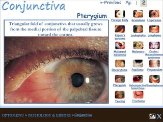 2←Previous 1Pg.
Pterygium
Triangular fold of conjunctiva that usually grows
from the medial portion of the palpebral fissure
toward the cornea.
Granuloma Hyperemia
Kaposi’s
sarcoma
Foreign body
Leukoplakia Lymphoma
Malignent
melanoma
Melanosis Ocular-
Mucocutaneous
syndromes
Oncocytoma Papilloma Pingueculum
Pterygium Subconjunctival
hemorrhage
Symblepharon
Tearing Trachoma
 