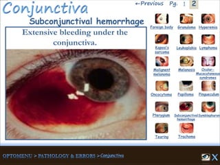2←Previous 1Pg.
Subconjunctival hemorrhage
Extensive bleeding under the
conjunctiva.
Granuloma Hyperemia
Kaposi’s
sarcoma
Foreign body
Leukoplakia Lymphoma
Malignent
melanoma
Melanosis Ocular-
Mucocutaneous
syndromes
Oncocytoma Papilloma Pingueculum
Pterygium Subconjunctival
hemorrhage
Symblepharon
Tearing Trachoma
 