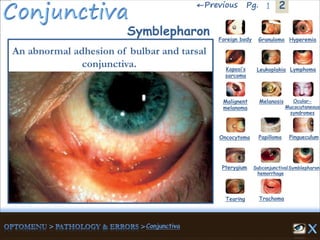2←Previous 1Pg.
Symblepharon
An abnormal adhesion of bulbar and tarsal
conjunctiva.
Granuloma Hyperemia
Kaposi’s
sarcoma
Foreign body
Leukoplakia Lymphoma
Malignent
melanoma
Melanosis Ocular-
Mucocutaneous
syndromes
Oncocytoma Papilloma Pingueculum
Pterygium Subconjunctival
hemorrhage
Symblepharon
Tearing Trachoma
 