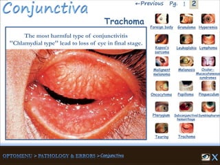 2←Previous 1Pg.
Trachoma
The most harmful type of conjunctivitis
''Chlamydial type'' lead to loss of eye in final stage.
Granuloma Hyperemia
Kaposi’s
sarcoma
Foreign body
Leukoplakia Lymphoma
Malignent
melanoma
Melanosis Ocular-
Mucocutaneous
syndromes
Oncocytoma Papilloma Pingueculum
Pterygium Subconjunctival
hemorrhage
Symblepharon
Tearing Trachoma
 