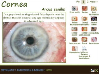 1 Next→Pg. 2
Arcus senilis Burning Band
keratopathy
Bullous
keratopathy
Corneal
dystrophies
Corneal
edema
Corneal
opacity
Corneal
ulcer-abscess
Foreign body
Hematocornea Injury Keratoconus
Keratoglobus Different
Between
Keratoconus &
Keratoglobus
Arcus senilis
Is a grayish-white ring-shaped fatty deposit near the
limbus that can occur at any age but usually appears
in advanced age.
 