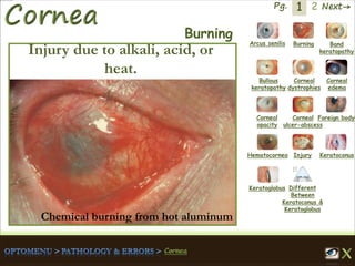 1 Next→Pg. 2
Arcus senilis Burning Band
keratopathy
Bullous
keratopathy
Corneal
dystrophies
Corneal
edema
Corneal
opacity
Corneal
ulcer-abscess
Foreign body
Hematocornea Injury Keratoconus
Keratoglobus Different
Between
Keratoconus &
Keratoglobus
Burning
Injury due to alkali, acid, or
heat.
Chemical burning from hot aluminum
 