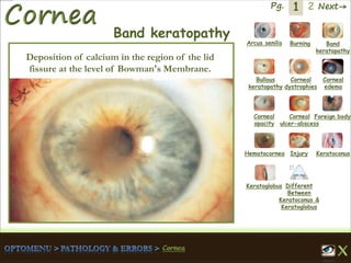 1 Next→Pg. 2
Arcus senilis Burning Band
keratopathy
Bullous
keratopathy
Corneal
dystrophies
Corneal
edema
Corneal
opacity
Corneal
ulcer-abscess
Foreign body
Hematocornea Injury Keratoconus
Keratoglobus Different
Between
Keratoconus &
Keratoglobus
Band keratopathy
Deposition of calcium in the region of the lid
fissure at the level of Bowman's Membrane.
 
