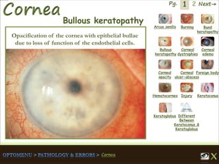 1 Next→Pg. 2
Arcus senilis Burning Band
keratopathy
Bullous
keratopathy
Corneal
dystrophies
Corneal
edema
Corneal
opacity
Corneal
ulcer-abscess
Foreign body
Hematocornea Injury Keratoconus
Keratoglobus Different
Between
Keratoconus &
Keratoglobus
Bullous keratopathy
Opacification of the cornea with epithelial bullae
due to loss of function of the endothelial cells.
 