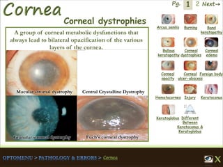 1 Next→Pg. 2
Macular stromal dystrophy
Granular stromal dystrophy
Central Crystalline Dystrophy
Fuch’s corneal dystrophy
Arcus senilis Burning Band
keratopathy
Bullous
keratopathy
Corneal
dystrophies
Corneal
edema
Corneal
opacity
Corneal
ulcer-abscess
Foreign body
Hematocornea Injury Keratoconus
Keratoglobus Different
Between
Keratoconus &
Keratoglobus
Corneal dystrophies
A group of corneal metabolic dysfunctions that
always lead to bilateral opacification of the various
layers of the cornea.
 