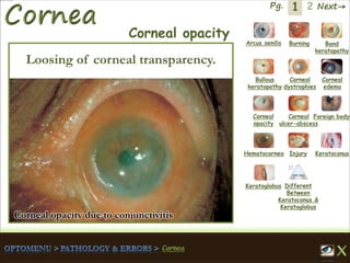 1 Next→Pg. 2
Arcus senilis Burning Band
keratopathy
Bullous
keratopathy
Corneal
dystrophies
Corneal
edema
Corneal
opacity
Corneal
ulcer-abscess
Foreign body
Hematocornea Injury Keratoconus
Keratoglobus Different
Between
Keratoconus &
Keratoglobus
Corneal opacity
Loosing of corneal transparency.
Corneal opacity due to conjunctivitis
 