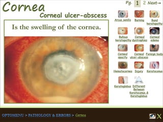 1 Next→Pg. 2
Arcus senilis Burning Band
keratopathy
Bullous
keratopathy
Corneal
dystrophies
Corneal
edema
Corneal
opacity
Corneal
ulcer-abscess
Foreign body
Hematocornea Injury Keratoconus
Keratoglobus Different
Between
Keratoconus &
Keratoglobus
Corneal ulcer-abscess
Is the swelling of the cornea.
 