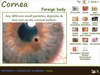 1 Next→Pg. 2
Arcus senilis Burning Band
keratopathy
Bullous
keratopathy
Corneal
dystrophies
Corneal
edema
Corneal
opacity
Corneal
ulcer-abscess
Foreign body
Hematocornea Injury Keratoconus
Keratoglobus Different
Between
Keratoconus &
Keratoglobus
Foreign body
Any different small particles, deposits, &
dust rest on the corneal surface.
 