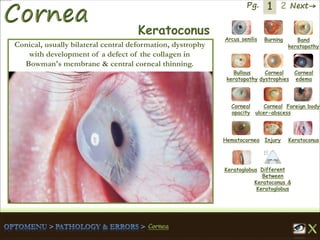 1 Next→Pg. 2
Arcus senilis Burning Band
keratopathy
Bullous
keratopathy
Corneal
dystrophies
Corneal
edema
Corneal
opacity
Corneal
ulcer-abscess
Foreign body
Hematocornea Injury Keratoconus
Keratoglobus Different
Between
Keratoconus &
Keratoglobus
Keratoconus
Conical, usually bilateral central deformation, dystrophy
with development of a defect of the collagen in
Bowman's membrane & central corneal thinning.
 