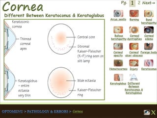 1 Next→Pg. 2
Arcus senilis Burning Band
keratopathy
Bullous
keratopathy
Corneal
dystrophies
Corneal
edema
Corneal
opacity
Corneal
ulcer-abscess
Foreign body
Hematocornea Injury Keratoconus
Keratoglobus Different
Between
Keratoconus &
Keratoglobus
Different Between Keratoconus & Keratoglobus
 