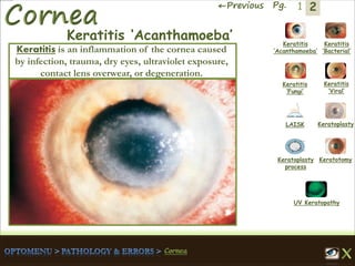 2←Previous Pg. 1
Keratitis
‘Acanthamoeba’
Keratitis
‘Bacterial’
Keratitis
‘Fungi’
Keratitis
‘Viral’
Keratoplasty
process
LAISK Keratoplasty
Keratotomy
UV Keratopathy
Keratitis ‘Acanthamoeba’
Keratitis is an inflammation of the cornea caused
by infection, trauma, dry eyes, ultraviolet exposure,
contact lens overwear, or degeneration.
 