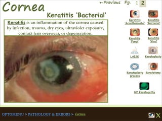 2←Previous Pg. 1
Keratitis
‘Acanthamoeba’
Keratitis
‘Bacterial’
Keratitis
‘Fungi’
Keratitis
‘Viral’
Keratoplasty
process
LAISK Keratoplasty
Keratotomy
UV Keratopathy
Keratitis ‘Bacterial’
Keratitis is an inflammation of the cornea caused
by infection, trauma, dry eyes, ultraviolet exposure,
contact lens overwear, or degeneration.
 