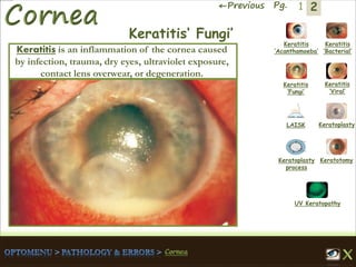 2←Previous Pg. 1
Keratitis
‘Acanthamoeba’
Keratitis
‘Bacterial’
Keratitis
‘Fungi’
Keratitis
‘Viral’
Keratoplasty
process
LAISK Keratoplasty
Keratotomy
UV Keratopathy
Keratitis‘ Fungi’
Keratitis is an inflammation of the cornea caused
by infection, trauma, dry eyes, ultraviolet exposure,
contact lens overwear, or degeneration.
 
