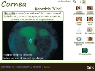 2←Previous Pg. 1
Keratitis
‘Acanthamoeba’
Keratitis
‘Bacterial’
Keratitis
‘Fungi’
Keratitis
‘Viral’
Keratoplasty
process
LAISK Keratoplasty
Keratotomy
UV Keratopathy
Keratitis ‘Viral’
Keratitis is an inflammation of the cornea caused
by infection, trauma, dry eyes, ultraviolet exposure,
contact lens overwear, or degeneration.
Herpes simplex keratitis
following use of steroid eye drops
 