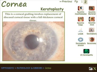 2←Previous Pg. 1
Keratitis
‘Acanthamoeba’
Keratitis
‘Bacterial’
Keratitis
‘Fungi’
Keratitis
‘Viral’
Keratoplasty
process
LAISK Keratoplasty
Keratotomy
UV Keratopathy
Keratoplasty
This is a corneal grafting involves replacement of
diseased corneal tissue with a full thickness corneal
tissue.
 