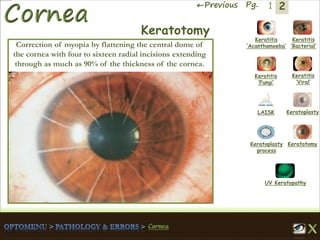 2←Previous Pg. 1
Keratitis
‘Acanthamoeba’
Keratitis
‘Bacterial’
Keratitis
‘Fungi’
Keratitis
‘Viral’
Keratoplasty
process
LAISK Keratoplasty
Keratotomy
UV Keratopathy
Keratotomy
Correction of myopia by flattening the central dome of
the cornea with four to sixteen radial incisions extending
through as much as 90% of the thickness of the cornea.
 