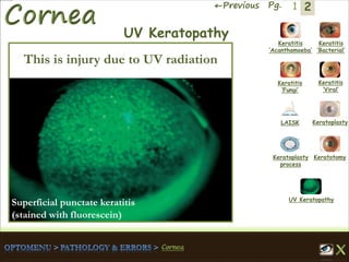 2←Previous Pg. 1
Keratitis
‘Acanthamoeba’
Keratitis
‘Bacterial’
Keratitis
‘Fungi’
Keratitis
‘Viral’
Keratoplasty
process
LAISK Keratoplasty
Keratotomy
UV Keratopathy
UV Keratopathy
This is injury due to UV radiation
Superficial punctate keratitis
(stained with fluorescein)
 