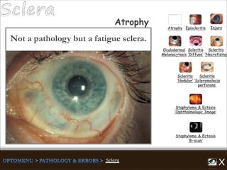 Atrophy Episcleritis Injury
Scleritis
‘Diffuse’
Scleritis
‘Necrotizing’
Scleritis
‘Nodular’
Scleritis
‘Scleromalacia
perforans’
Staphyloma & Ectasia
‘B-scan’
Staphyloma & Ectasia
‘Ophthalmologic Image’
Atrophy
Not a pathology but a fatigue sclera.
Oculodermal
Melanocytosis
 