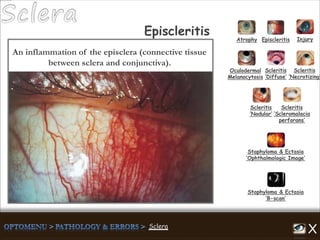 Atrophy Episcleritis Injury
Scleritis
‘Diffuse’
Scleritis
‘Necrotizing’
Scleritis
‘Nodular’
Scleritis
‘Scleromalacia
perforans’
Staphyloma & Ectasia
‘B-scan’
Staphyloma & Ectasia
‘Ophthalmologic Image’
Episcleritis
Oculodermal
Melanocytosis
An inflammation of the episclera (connective tissue
between sclera and conjunctiva).
 