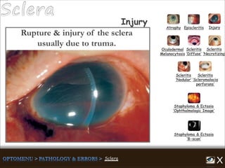 Atrophy Episcleritis Injury
Scleritis
‘Diffuse’
Scleritis
‘Necrotizing’
Scleritis
‘Nodular’
Scleritis
‘Scleromalacia
perforans’
Staphyloma & Ectasia
‘B-scan’
Staphyloma & Ectasia
‘Ophthalmologic Image’
Injury
Oculodermal
Melanocytosis
Rupture & injury of the sclera
usually due to truma.
 
