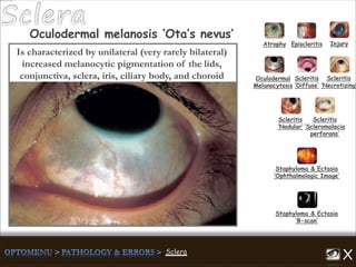 Atrophy Episcleritis Injury
Scleritis
‘Diffuse’
Scleritis
‘Necrotizing’
Scleritis
‘Nodular’
Scleritis
‘Scleromalacia
perforans’
Staphyloma & Ectasia
‘B-scan’
Staphyloma & Ectasia
‘Ophthalmologic Image’
Oculodermal melanosis ‘Ota’s nevus’
Oculodermal
Melanocytosis
Is characterized by unilateral (very rarely bilateral)
increased melanocytic pigmentation of the lids,
conjunctiva, sclera, iris, ciliary body, and choroid
 