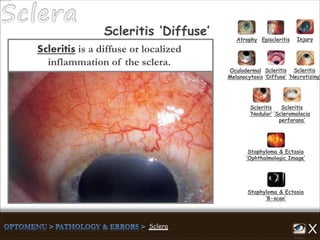 Scleritis is a diffuse or localized
inflammation of the sclera.
Atrophy Episcleritis Injury
Scleritis
‘Diffuse’
Scleritis
‘Necrotizing’
Scleritis
‘Nodular’
Scleritis
‘Scleromalacia
perforans’
Staphyloma & Ectasia
‘B-scan’
Staphyloma & Ectasia
‘Ophthalmologic Image’
Scleritis ‘Diffuse’
Oculodermal
Melanocytosis
 