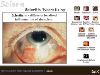 Scleritis is a diffuse or localized
inflammation of the sclera.
Atrophy Episcleritis Injury
Scleritis
‘Diffuse’
Scleritis
‘Necrotizing’
Scleritis
‘Nodular’
Scleritis
‘Scleromalacia
perforans’
Staphyloma & Ectasia
‘B-scan’
Staphyloma & Ectasia
‘Ophthalmologic Image’
Scleritis ‘Necrotizing’
Oculodermal
Melanocytosis
 