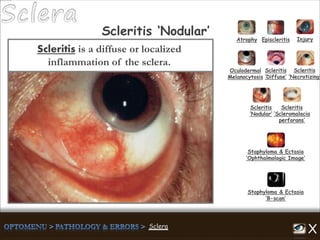 Scleritis is a diffuse or localized
inflammation of the sclera.
Atrophy Episcleritis Injury
Scleritis
‘Diffuse’
Scleritis
‘Necrotizing’
Scleritis
‘Nodular’
Scleritis
‘Scleromalacia
perforans’
Staphyloma & Ectasia
‘B-scan’
Staphyloma & Ectasia
‘Ophthalmologic Image’
Scleritis ‘Nodular’
Oculodermal
Melanocytosis
 