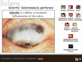 Scleritis is a diffuse or localized
inflammation of the sclera.
Atrophy Episcleritis Injury
Scleritis
‘Diffuse’
Scleritis
‘Necrotizing’
Scleritis
‘Nodular’
Scleritis
‘Scleromalacia
perforans’
Staphyloma & Ectasia
‘B-scan’
Staphyloma & Ectasia
‘Ophthalmologic Image’
Scleritis ‘Scleromalacia perforans’
Oculodermal
Melanocytosis
 