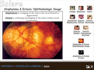 Atrophy Episcleritis Injury
Scleritis
‘Diffuse’
Scleritis
‘Necrotizing’
Scleritis
‘Nodular’
Scleritis
‘Scleromalacia
perforans’
Staphyloma & Ectasia
‘B-scan’
Staphyloma & Ectasia
‘Ophthalmologic Image’
Staphyloma & Ectasia ‘Ophthalmologic Image’
Oculodermal
Melanocytosis
Staphyloma is a bulging of the sclera with uveal thinned or
degenerated.
Ectasia is a thinning and bulging of the sclera without uveal
involvement.
 